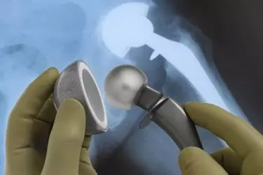 best hospital for hip replacement surgery in Katihar, best doctor for hip replacement surgery in Katihar, cost of hip replacement surgery in Katihar