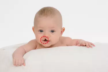 best hospital for cleft lip palate surgery in Katihar, best doctor for cleft lip palate surgery in Katihar, cost of cleft lip palate surgery in Katihar